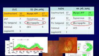 OCT et glaucome [upl. by Enninaej]