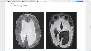 NEURORADIOLOGY EXAM CASES LECTURE [upl. by Ellersick]