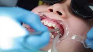 Braces Putting Braces On Bonding Procedure  Aura Orthodontics [upl. by Atika362]