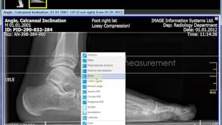 Orthopedic Measurements using iQVIEW 28 Calcaneus Inclination Angle [upl. by Nerwal635]