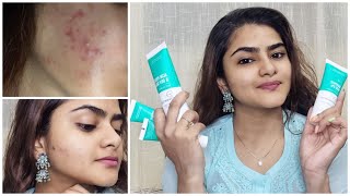 How to get Rid of Acne and Pimples  Acne Treatment  Dermatouch [upl. by Ahsia357]