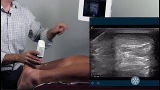 Diagnostic ultrasound in Podiatry  Benjamin Marble DPM [upl. by Acinorev]