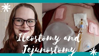 I had Ileostomy and Jejunostomy Surgery During a Pandemic [upl. by Rustie]