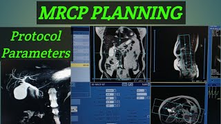 MRCP PLANNING step by step MRCP planning or protocol Mrcp planning GE machine [upl. by Donaugh]