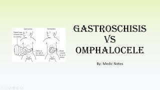 Gastroschisis vs omphalocele [upl. by Constancia]