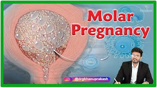 Molar Pregnancy  Causes Clinical manifestations Diagnosis and Treatment [upl. by Fife274]