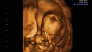 Ecografia 16 semanas 4D y 2D Ultrasound Irati [upl. by Akemahc960]