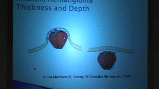 Laser Treatment for Hemangiomas Sorting Through the Myths [upl. by Agon]