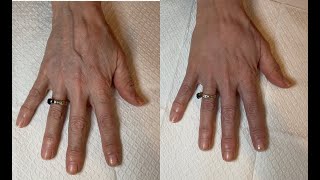 Radiesse dermal filler for Hands [upl. by Attenol]