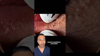 Your lip balm might be causing this Blackheads removal  Dr Somji reacts [upl. by Kopans]