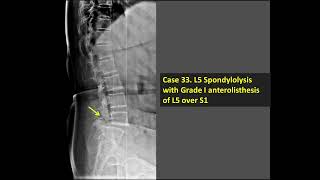 L5 Spondylolysis With Grade I Anterolisthesis Of L5 Over S1 XRay [upl. by Parke78]