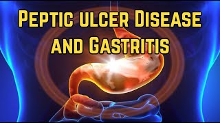 Peptic Ulcer Disease and Gastritis  CRASH Medical Review Series [upl. by Yrannav360]