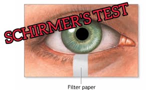 SCHIRMERS TEST IS EXPLAINED IN TAMIL [upl. by Seravat]