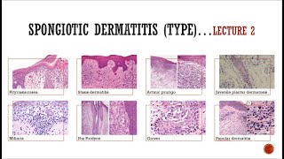 5 Spongiotic Dermatitis 2 [upl. by Aveneg]