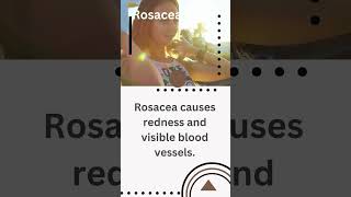 Rosacea Care 15 [upl. by Sheffield]