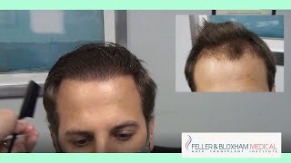 Repair of FUE Hair Transplant  Feller amp Bloxham Medical  NY NYC Long Island amp Philadelphia [upl. by Leahcir]