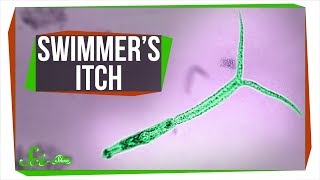 The Horrifying Truth About Swimmers Itch [upl. by Ariajaj]