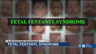 Severe birth defects found in 30 babies may be linked to fentanyl use during pregnancy [upl. by Keryt112]