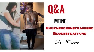 QampA Bauchdeckenstraffung Bruststraffung bei DR KLOSE [upl. by Bohs]