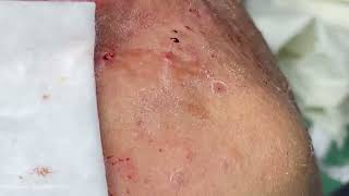 Big Cystic Acne Blackheads Extraction Blackheads amp Milia Whiteheads Removal Pimple Popping [upl. by Ettevol]