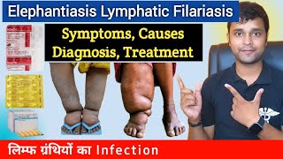 Elephantiasis  Filariasis  Symptoms Causes Diagnosis Treatment Prevention In Hindi [upl. by Elsy769]