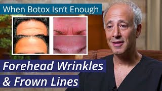 Treating Forehead Wrinkles  How to get rid of Stubborn ForeheadLines when Botox isnt Enough [upl. by Ellecrad]