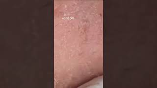 Pickel Ausdrücken Blackheads Akne amp Mitesser entfernen 🔴 19 [upl. by Ynner933]