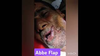 ABBE FLAP BY DrRobiul islam Rony [upl. by Brennen33]