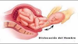 Lesiones asociadas al nacimiento [upl. by Pilar]