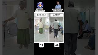 Hip Replacement BEFORE amp AFTER viralvideo shorts trending youtubeshorts pain surgeryday [upl. by Eladnor]