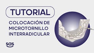 Vídeo de colocación de microtornillo interradicular [upl. by Aikemet334]