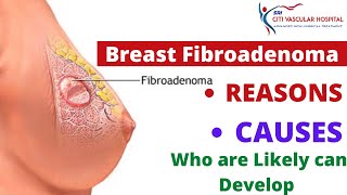 Breast Fibroadenoma  Causes and Risk Factors  Who are likely to develop benign breast lumps [upl. by Lemyt]