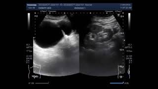 Ultrasound Video showing two cases Diverticulum of the urinary bladder and Prostatic Utricle Cyst [upl. by Ynnod]