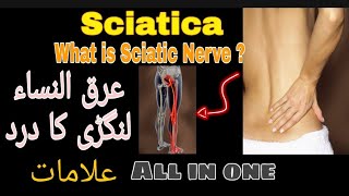 Sciatica  Sciatica Nerve Pain Causes Symptoms diagnosis  what is sciatic Nerve [upl. by Enimasaj]