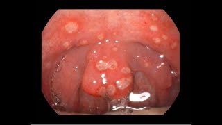 Acute Ulcerative Pharyngitis Causing Severe Sorethroat [upl. by Ybbob]