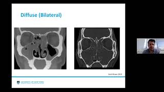 Rhinosinusitis EPOS 2020 Update [upl. by Annola]