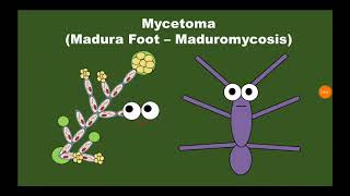 7 Mycetoma الورم الفطري [upl. by Apoor]