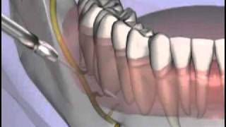 Malameds Local Anesthesia 11 Supplemental Injection Techniques [upl. by Notlaw]