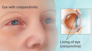 Conjunctivitis  Ophthalmology Videos [upl. by Maram]