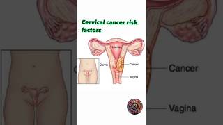 Cervical cancer risk factors awareness medicalscience shortsfeeds [upl. by Jud]