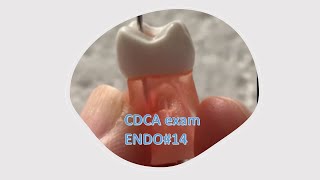 ADEX 14 ENDO tips [upl. by Aroc683]