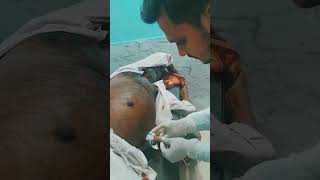 Ascitic Fluid Drain doctor drsatyampathak asciticfluid medicotips abdomen tb cancer [upl. by Siclari233]