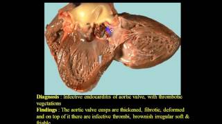 Pathology Second  Dr Nafea  Thrombosis 1 [upl. by Akeemaj951]