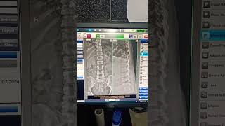 L S Spine x ray 😧 [upl. by Anilasor]