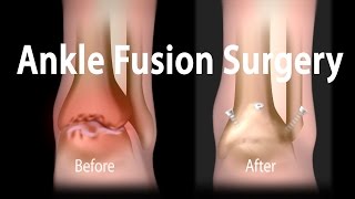 Ankle Fusion Surgery Animation [upl. by Aidualk]