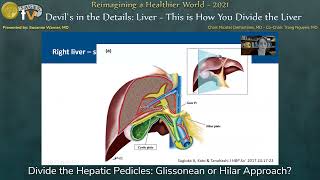 Divide the Hepatic Pedicles Glissonean or Hilar Approach [upl. by Lorrad]