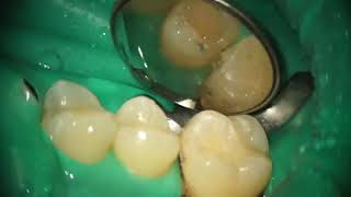 Interproximal Resin Restoration [upl. by Tiffany]