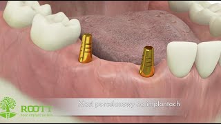 Uzupełnienie braków zębowych za pomocą mostu na dwóch implantach [upl. by Alenoel]