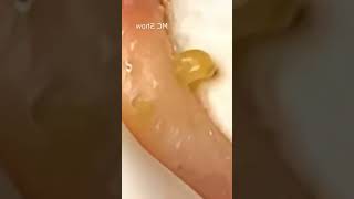 Pickel Ausdrücken Blackheads Akne amp Mitesser entfernen 🔴 20 [upl. by Paloma]