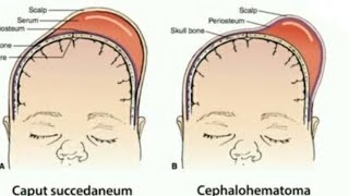 Caput succedaneum vs cephalhematoma [upl. by Aliam]